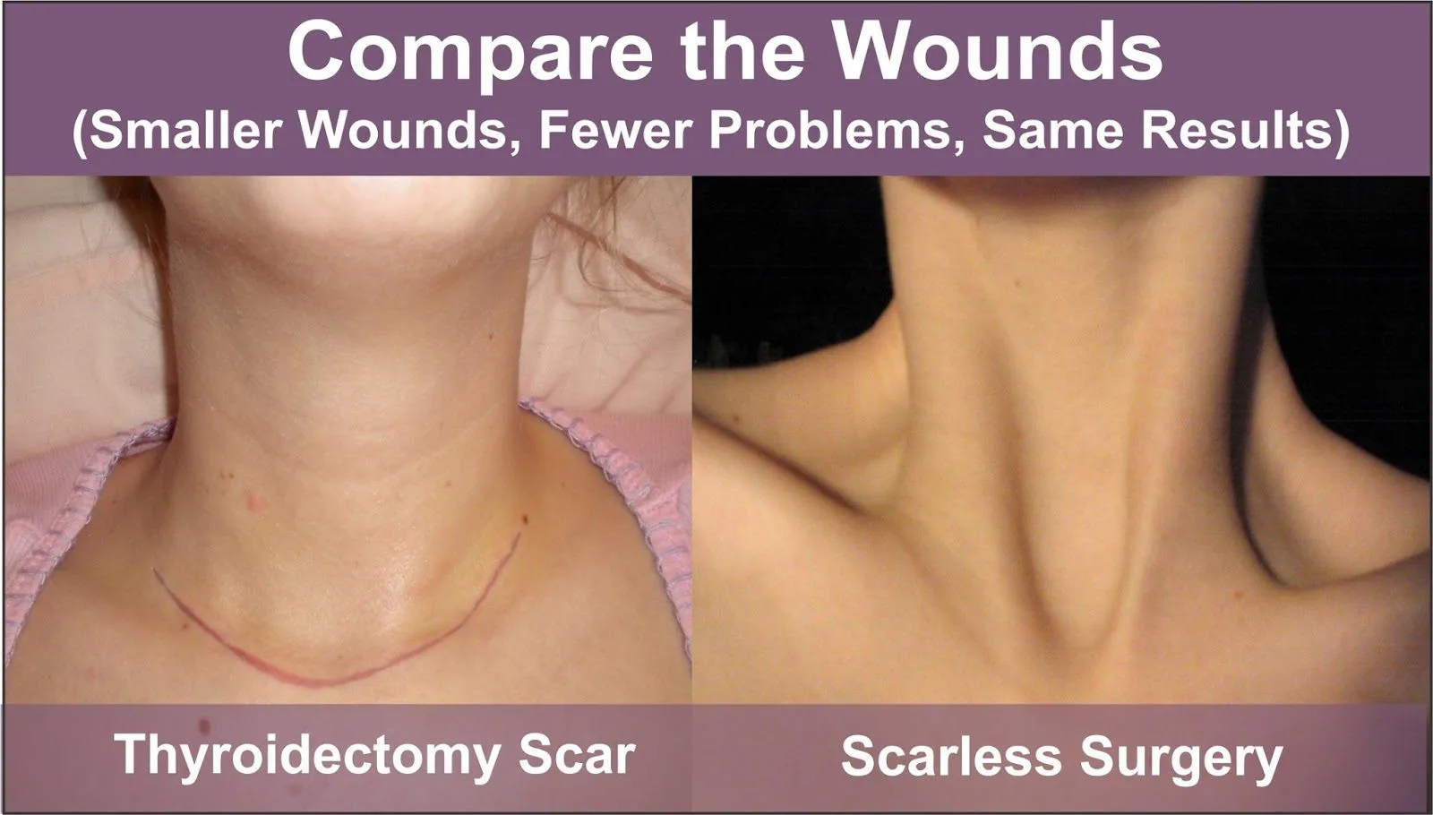 Endoscopic Scarless Thyroid Surgery